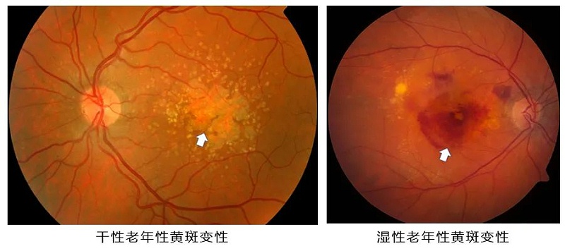 水蛭素、黄斑变性