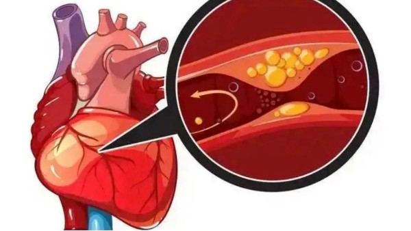 真实案例：是什么让他坚持一年，冠状动脉堵塞消除30%！