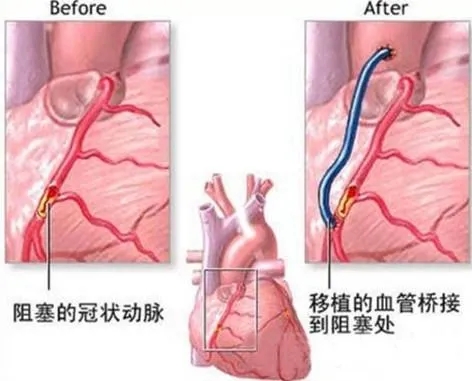 水蛭素、血管堵塞、中风