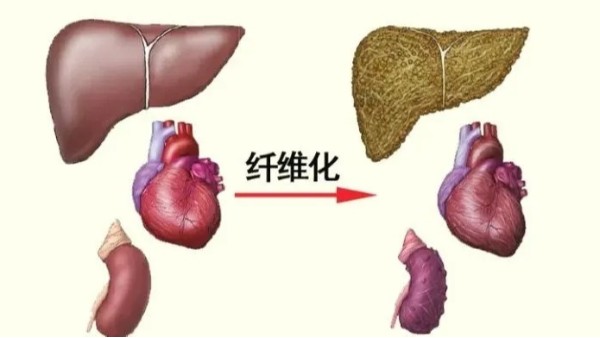 水蛭是临床常用的活血药物，能有效治疗器官纤维化