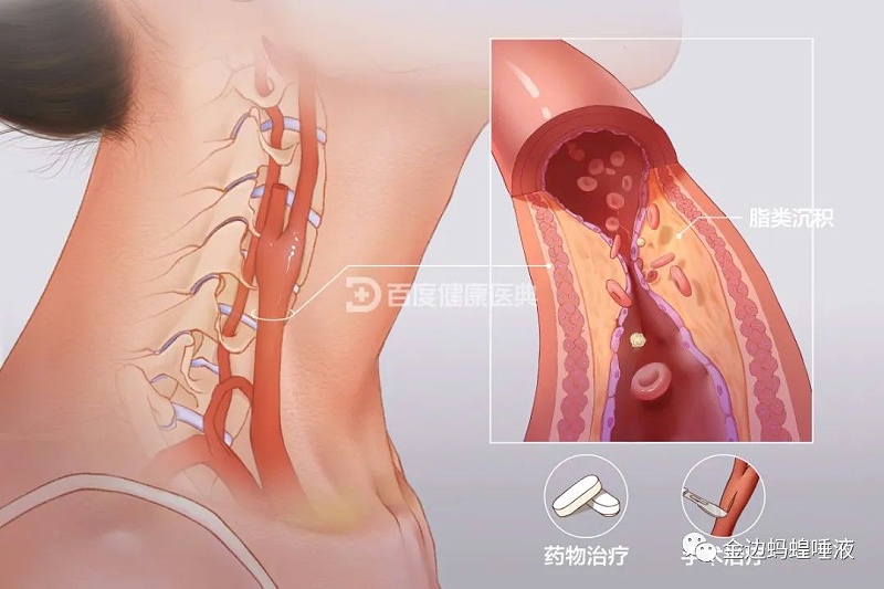 壮医水蛭疗法，天然水蛭素胶囊