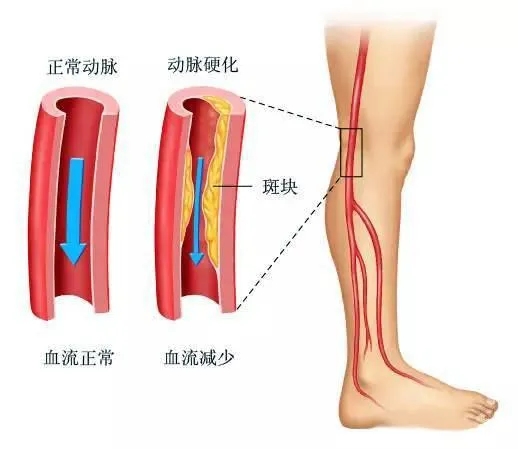 水蛭素、下肢动脉硬化、下肢闭塞