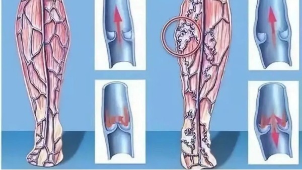 真实案例：有一种让人“生不如死”的痛，叫做脉管炎！