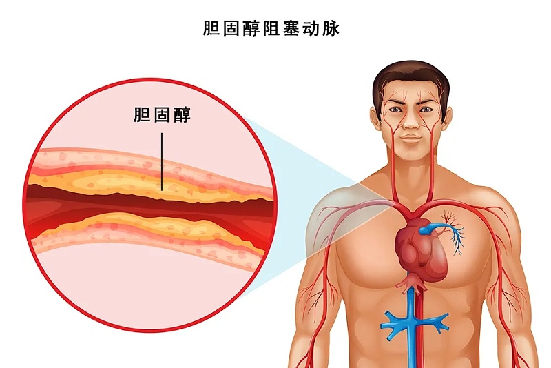 水蛭素、脖子粗、血管硬化