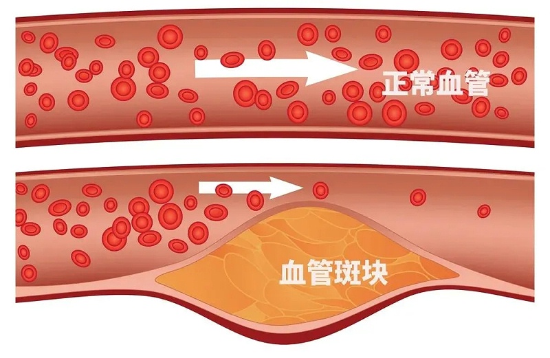 水蛭素、通血管、血管堵塞