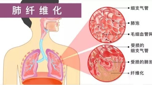 研究称水蛭素可通过调控p38 MAPK/NF-κB信号通路抗肺纤维化