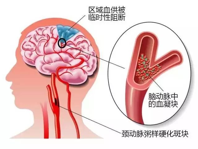 脑梗塞有什么预防方法