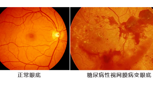 糖尿病性视网膜病变严重可致盲，水蛭或可延缓疾病进展