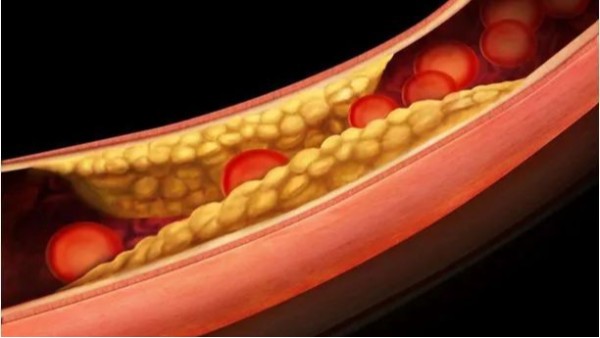 三高如何引起动脉粥样硬化斑块？——高血压篇