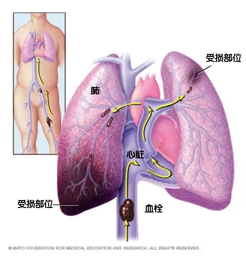 水蛭素、猝死、心梗